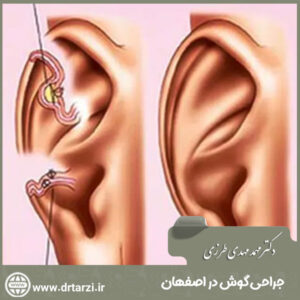 جراحی گوش در اصفهان - دکتر طرزی