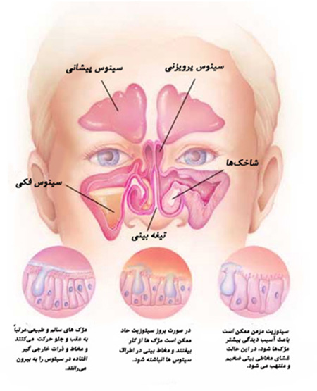 انسداد بینی- دکتر طرزی